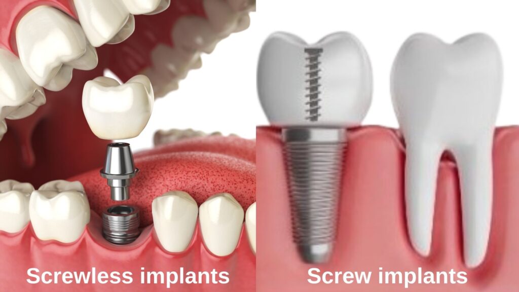 screwless dental implants vs. screw dental implants