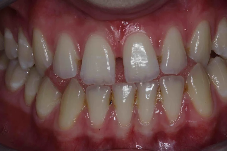 A picture of a person's teeth with dental fillings