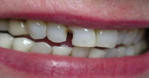 How to whiten dental fillings