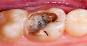A picture taken from a temporary filling