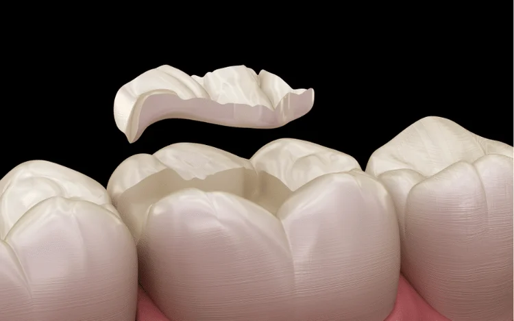 A picture of a temporary tooth filling