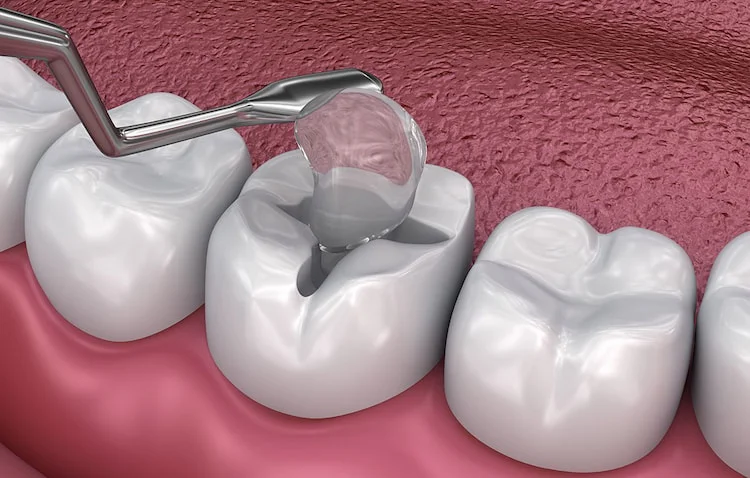 A picture representing temporary dental filling