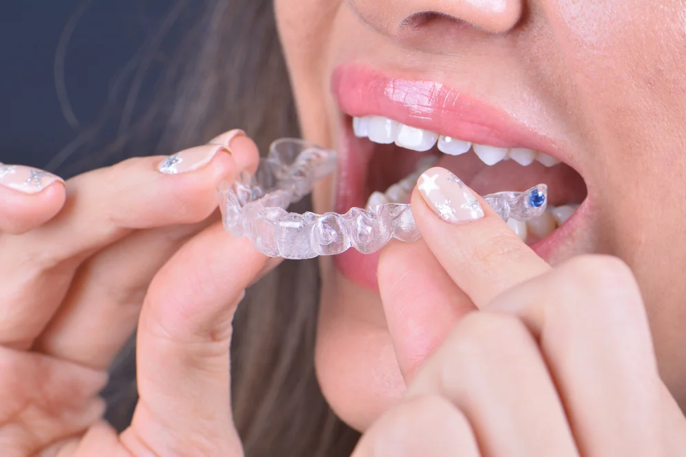 Invisalign candidacy factors