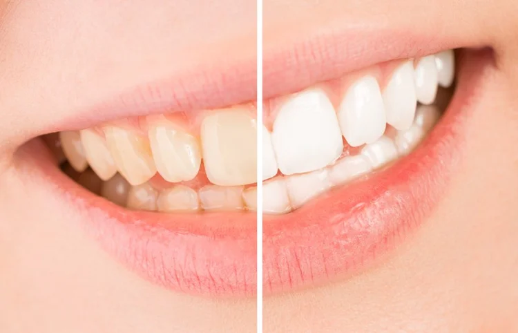 A before and after image about teeth whitening