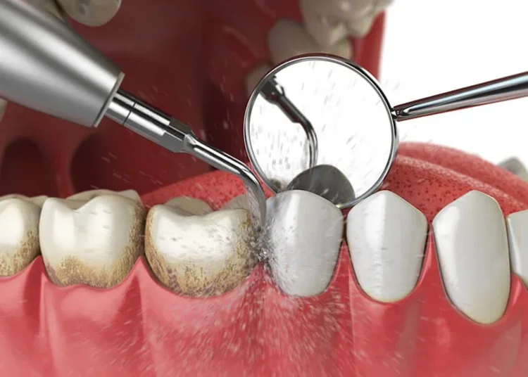 a close up picture of teeth whitening